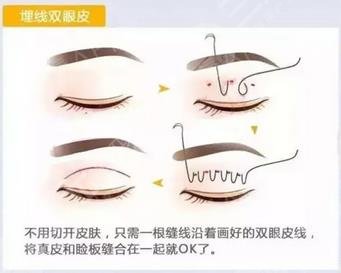 雙眼皮手術(shù)過程