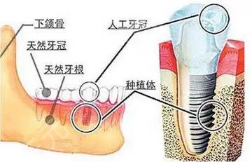 牙齒種植原理