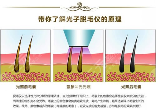 激光脫毛