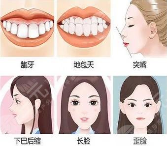 牙齒矯正適應(yīng)癥