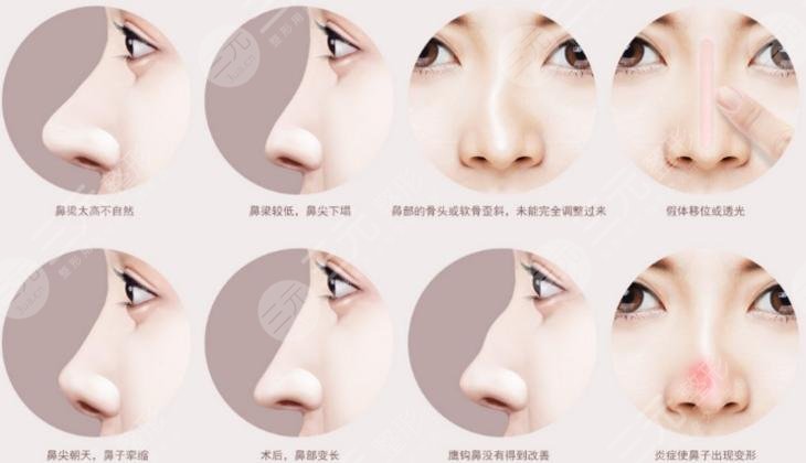鼻子有點(diǎn)歪怎么辦?可以調(diào)整嗎?