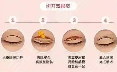 雙眼皮手術(shù)過程