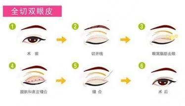 全切雙眼皮手術