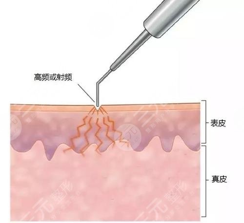 點痣后要注意什么?多久才能碰水?