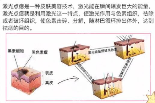 點痣后要注意什么?多久才能碰水?