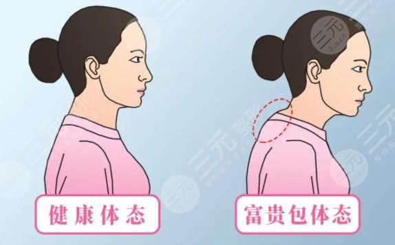 富貴包怎么消除有?