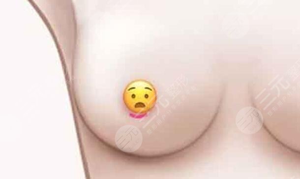 璀璨隆胸假體大概多少錢？