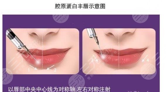 唇形不好看怎么矯正？整形果怎么樣？注意事項(xiàng)+適合人群盤點(diǎn)！