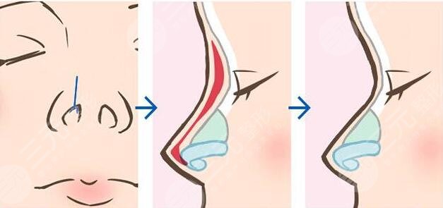 超體隆鼻后期會(huì)有什么問(wèn)題