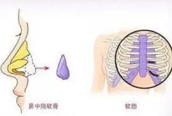 肋骨隆鼻三個(gè)月變化圖  　　1、手術(shù)前