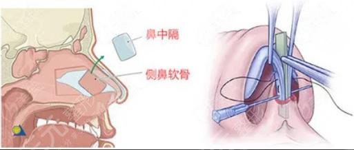 超肋骨鼻可以維持多久?