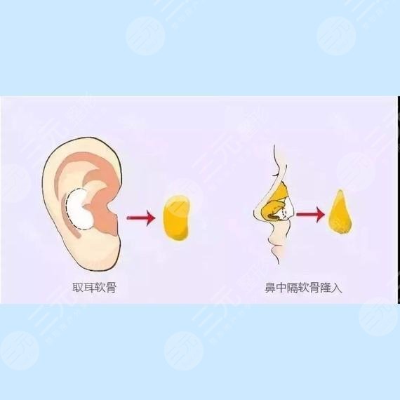 耳軟骨隆鼻恢復(fù)過程圖片果|案例展示