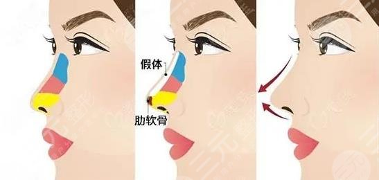 中山人民醫(yī)院隆鼻怎么樣？
