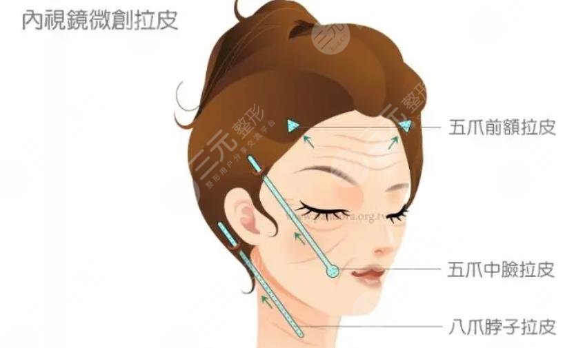 美容拉皮手術需要多少錢呢