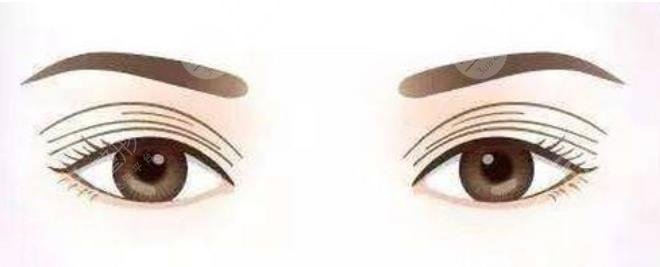 雙眼皮修復(fù)