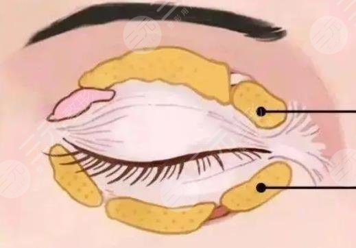雙眼皮修復(fù)