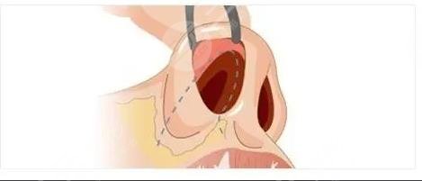 鼻子修復(fù)必須要滿3個(gè)月嗎？二次鼻整形術(shù)前指南！小白必看~