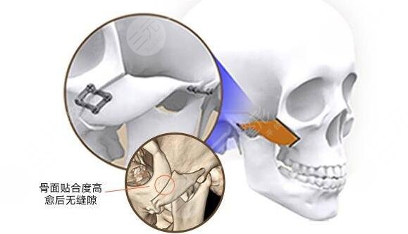 磨顴骨前后對(duì)比圖