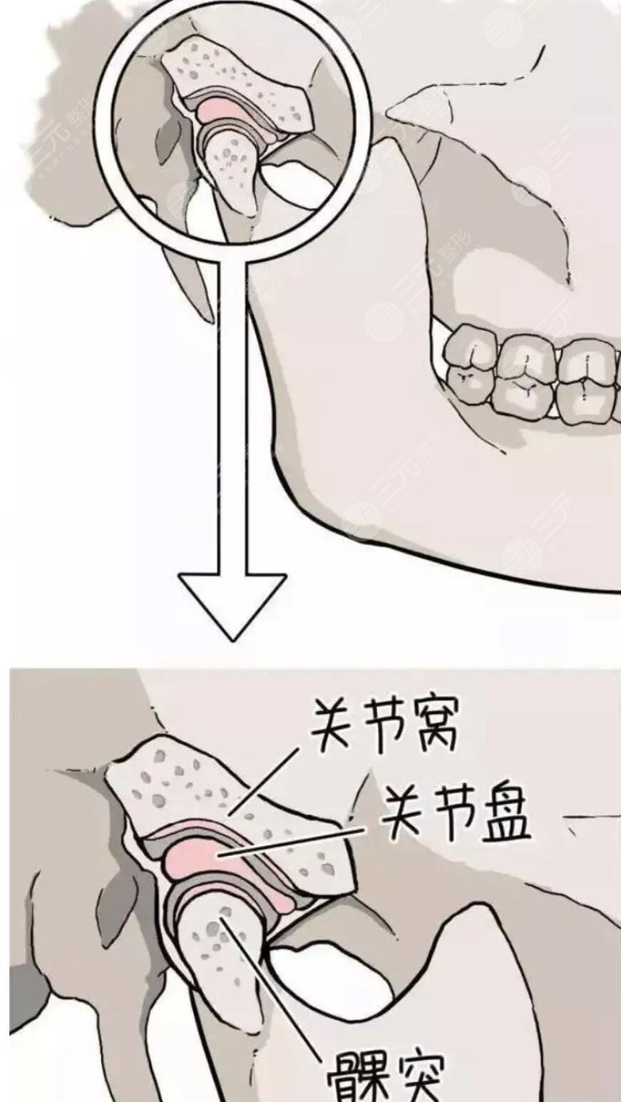 下顎骨太寬做手術多少錢