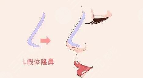 假體隆鼻
