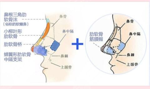 軟骨隆鼻