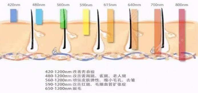 黑頭怎么去除有？激光去黑頭好處、注意事項(xiàng)等趕緊get上！