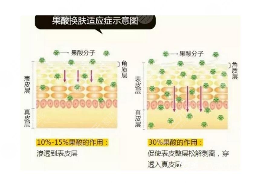果酸換膚案例：果酸換膚前后對(duì)比照片曝光