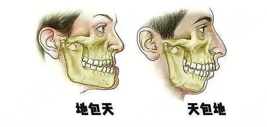 天包地矯正后臉型變化圖共享，矯正前的“如花”，矯正后的“側(cè)顏女神”~