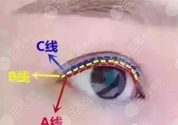 美瞳線后