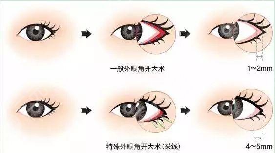 10個開內眼角9個留疤是真的嗎?