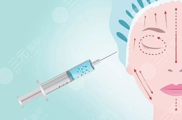 玻尿酸填充法令紋多少錢