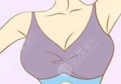 深圳人民醫(yī)院于麗醫(yī)生隆胸案例分享
