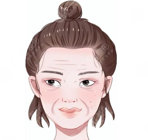 激光去皺