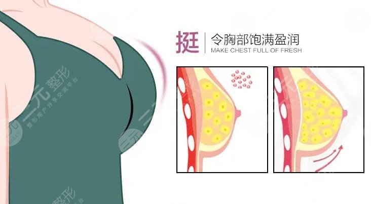 自體脂肪隆胸