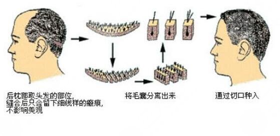 毛發(fā)移植