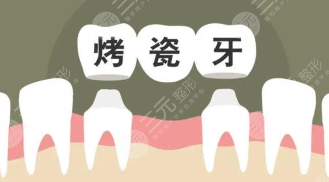 烤瓷牙多少錢一顆價格表2022全國，烤瓷牙壽命可以保持幾年？收藏不虧！