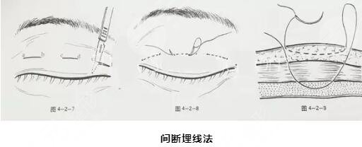 眼部整形