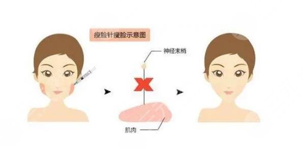 怎么讓下頜緣緊致?