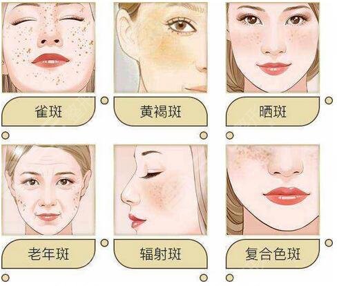 怎樣去除老年斑