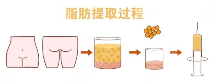 自體脂肪填充