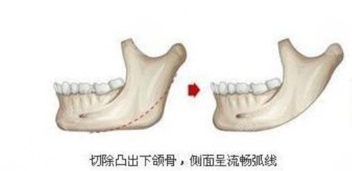 下頜角