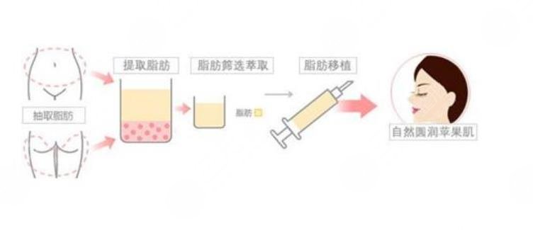 自體脂肪豐蘋(píng)果肌果好嗎