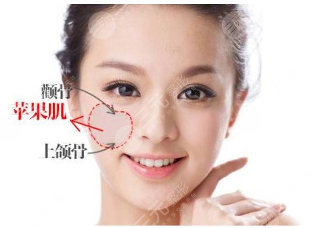 自體脂肪豐蘋(píng)果肌果好嗎