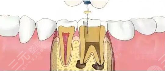 根管緩解后悔一輩子是真的嗎？為什么會(huì)后悔？根管緩解果可以維持多久？