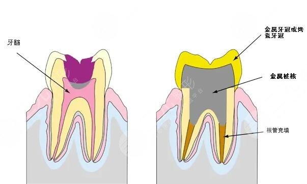 根管緩解持時(shí)間是多久？