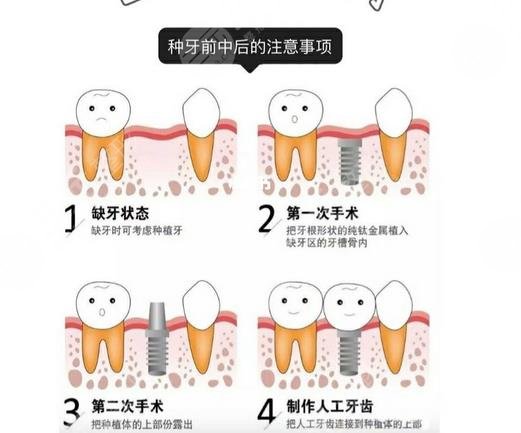 種植牙