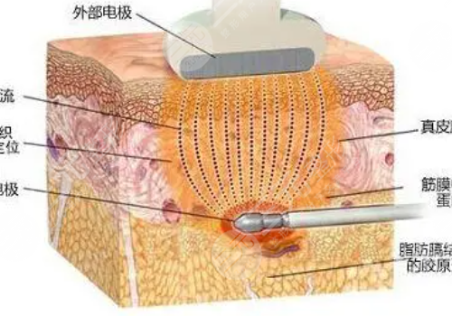 鐳射溶脂和激光溶脂的優(yōu)勢(shì)