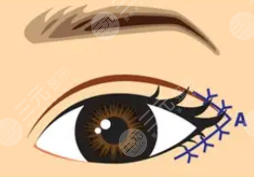開眼角疼不疼?和不開的區(qū)別是什么?