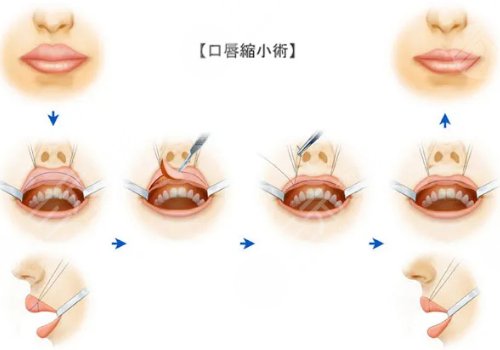 厚唇變薄手術(shù)多少錢？
