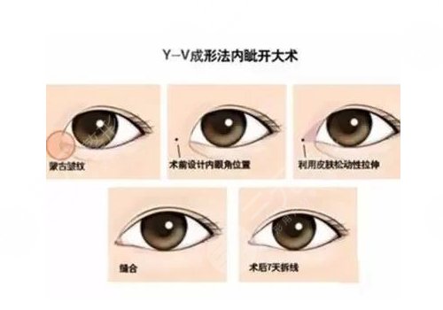 開眼角疼不疼?